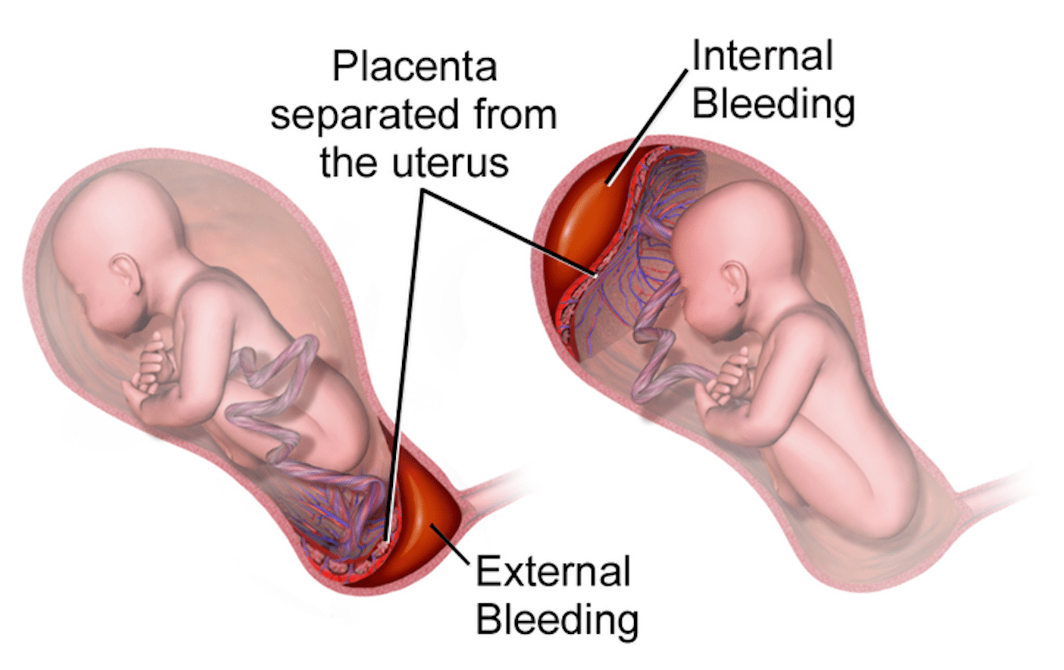 Abruptio placenta