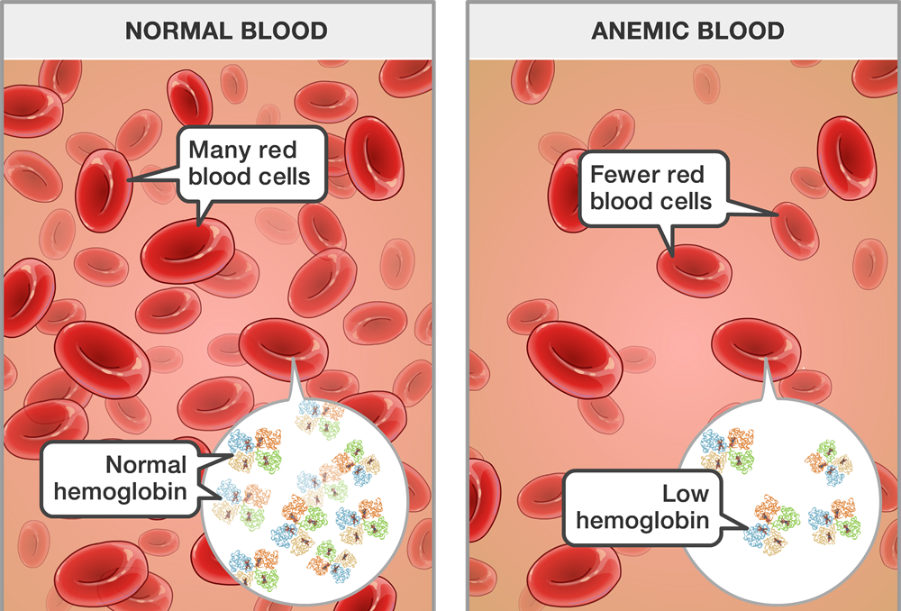 Classifications of Anaemia | CHAPTER 11 | Pediatric Nursing