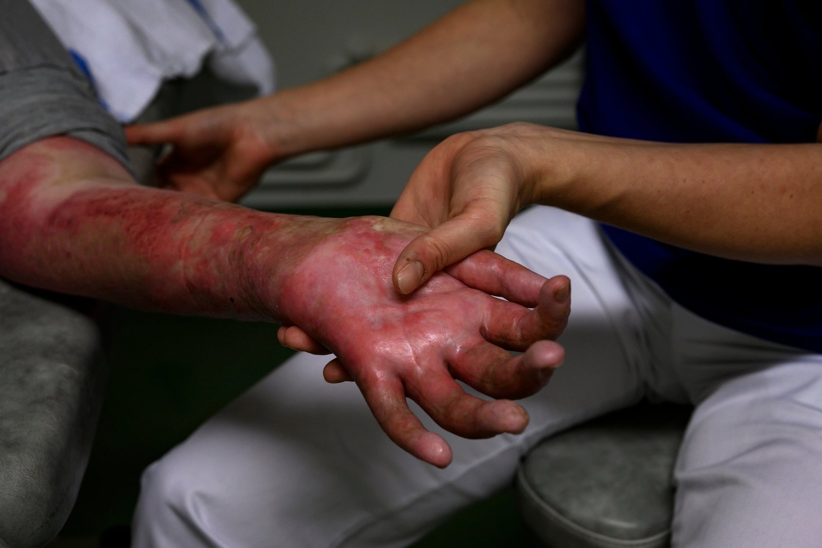 Concept about Burn | CHAPTER 11 | Anatomy and Physiology