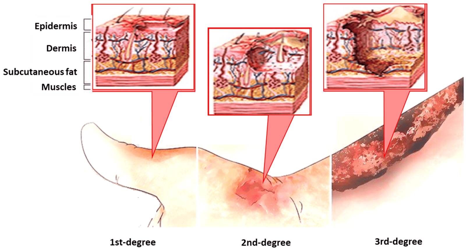 Concept about Burn | CHAPTER 11 | Anatomy and Physiology