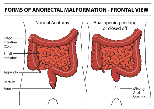 Anorectal malformation/Imperforated anus mean