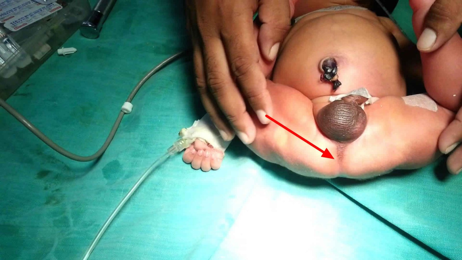 Anorectal malformation/Imperforated anus mean