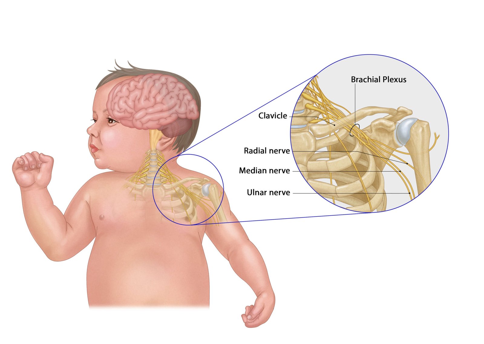 Brachial plexus palsy or Erb's palsy