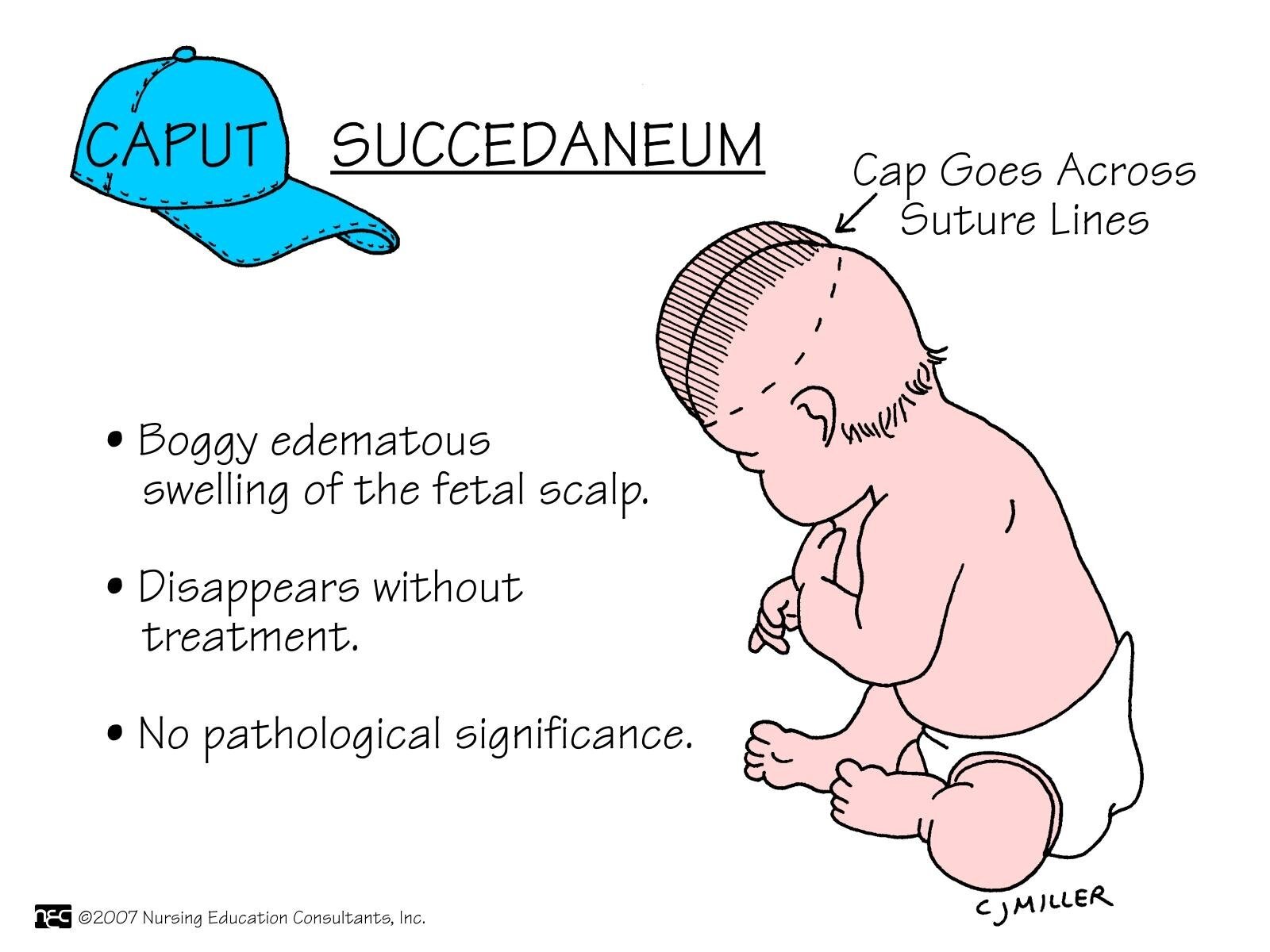 Caput succedaneum and Cephalohematoma