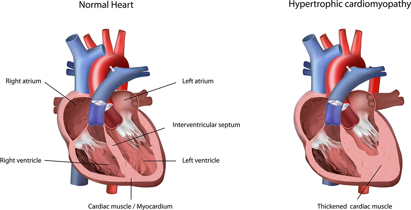 Concept about Carditis | CHAPTER 10 | Pediatric Nursing
