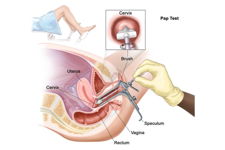 Cervical cancer screening