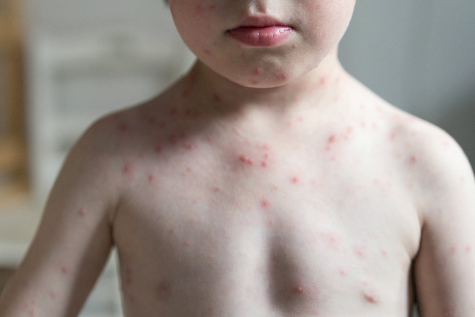 Concept about Chickenpox | CHAPTER 13 | Pediatric Nursing