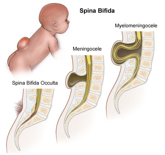 Classification of Meningocelt / myelomeningocele