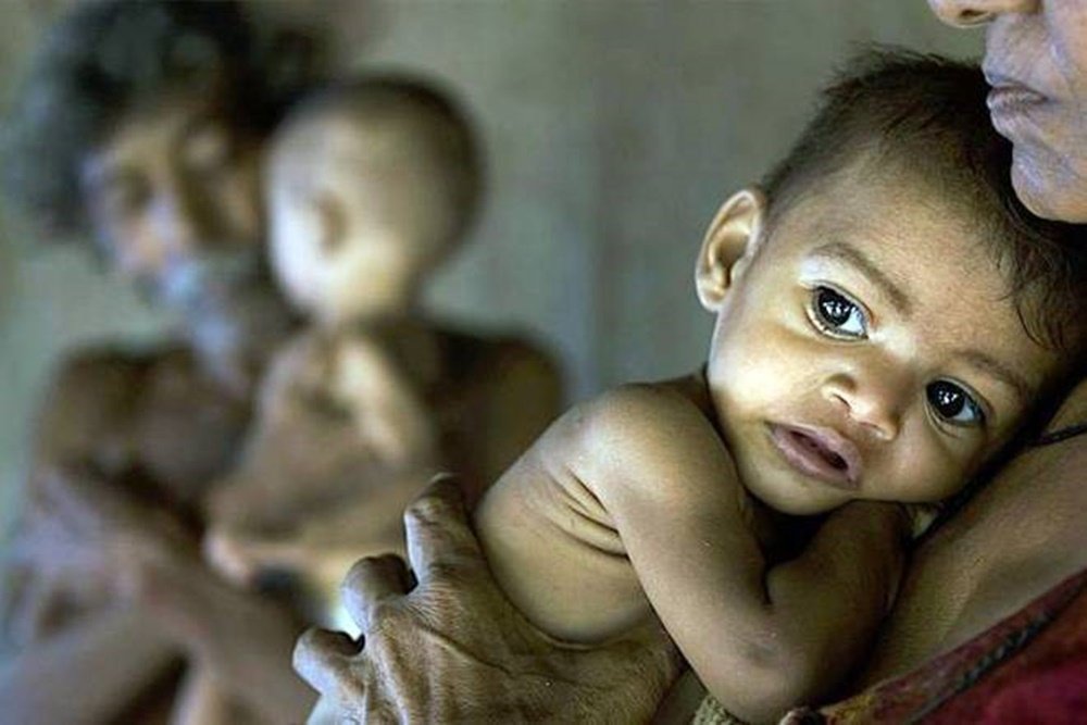 Concept about Malnutrition | CHAPTER 15 | Pediatric Nursing