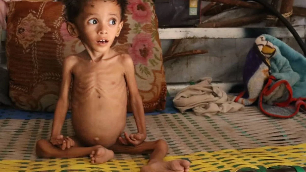 Concept about Malnutrition | CHAPTER 15 | Pediatric Nursing