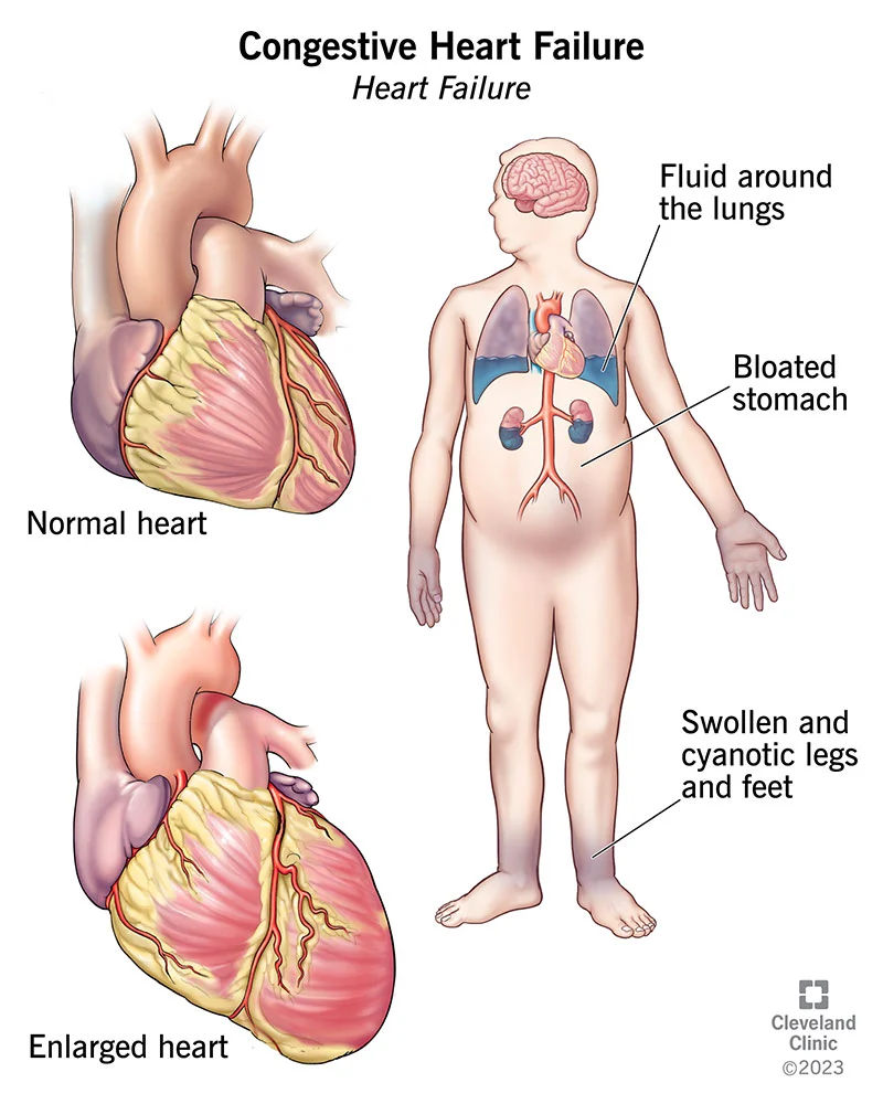 Congestive Heart Failure | CHAPTER 10 | Pediatric Nursing