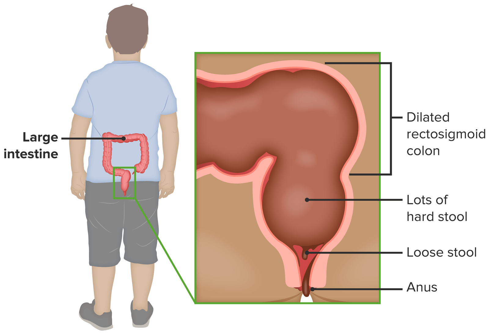 Concept about Encopresis | CHAPTER 4 | Psychiatric nursing