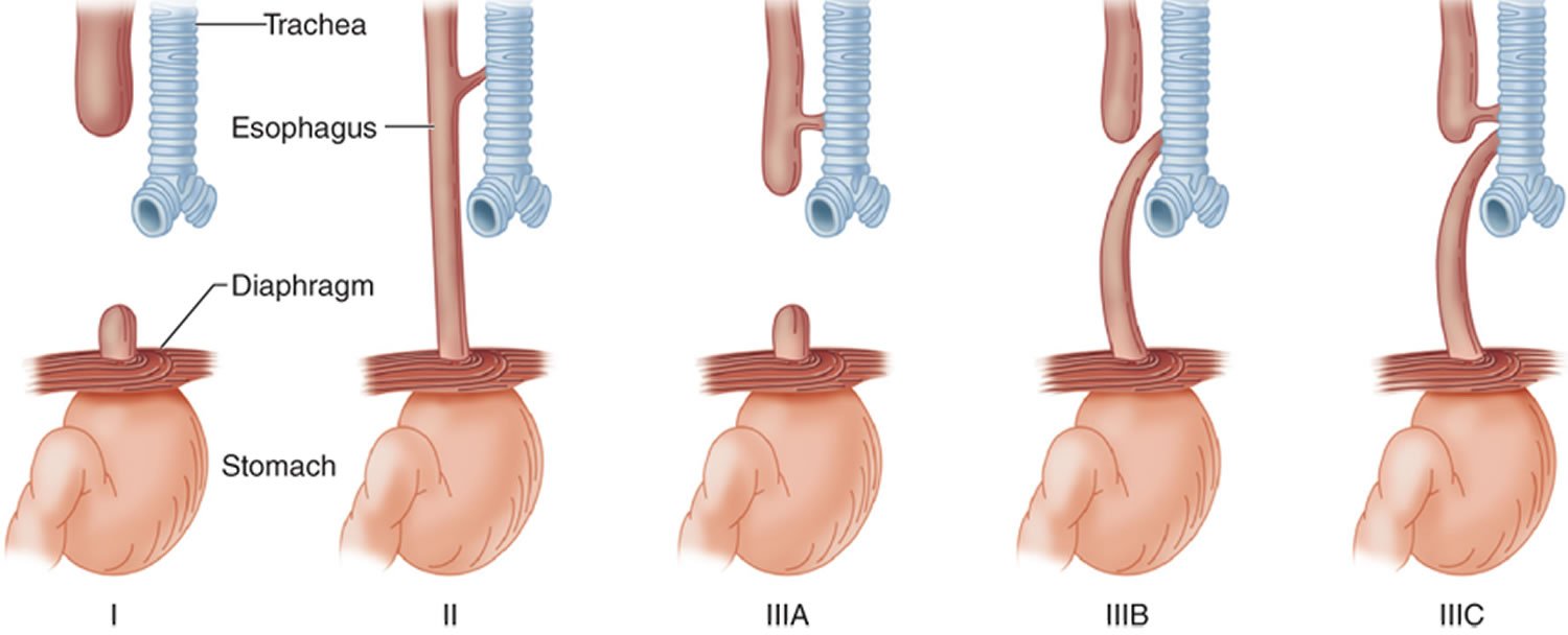 Esophageal atresia/tracheoesophageal fistula