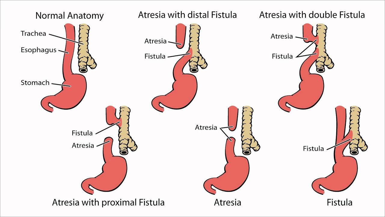 Esophageal atresia/tracheoesophageal fistula