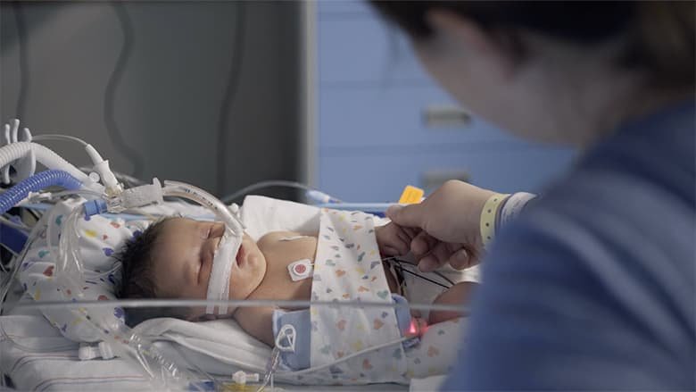 Classification of Gastroschisis