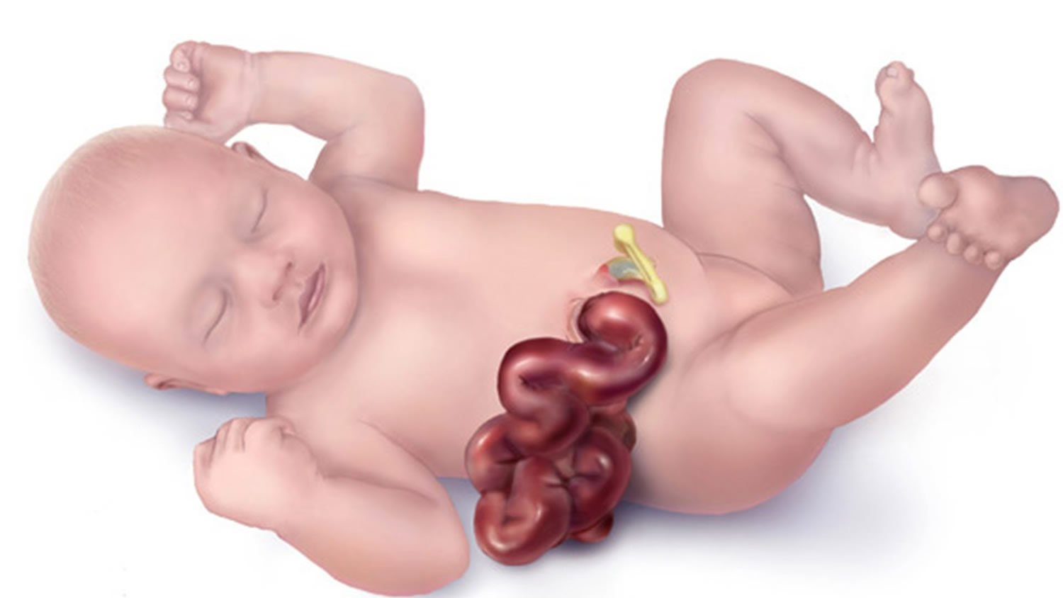 Classification of Gastroschisis