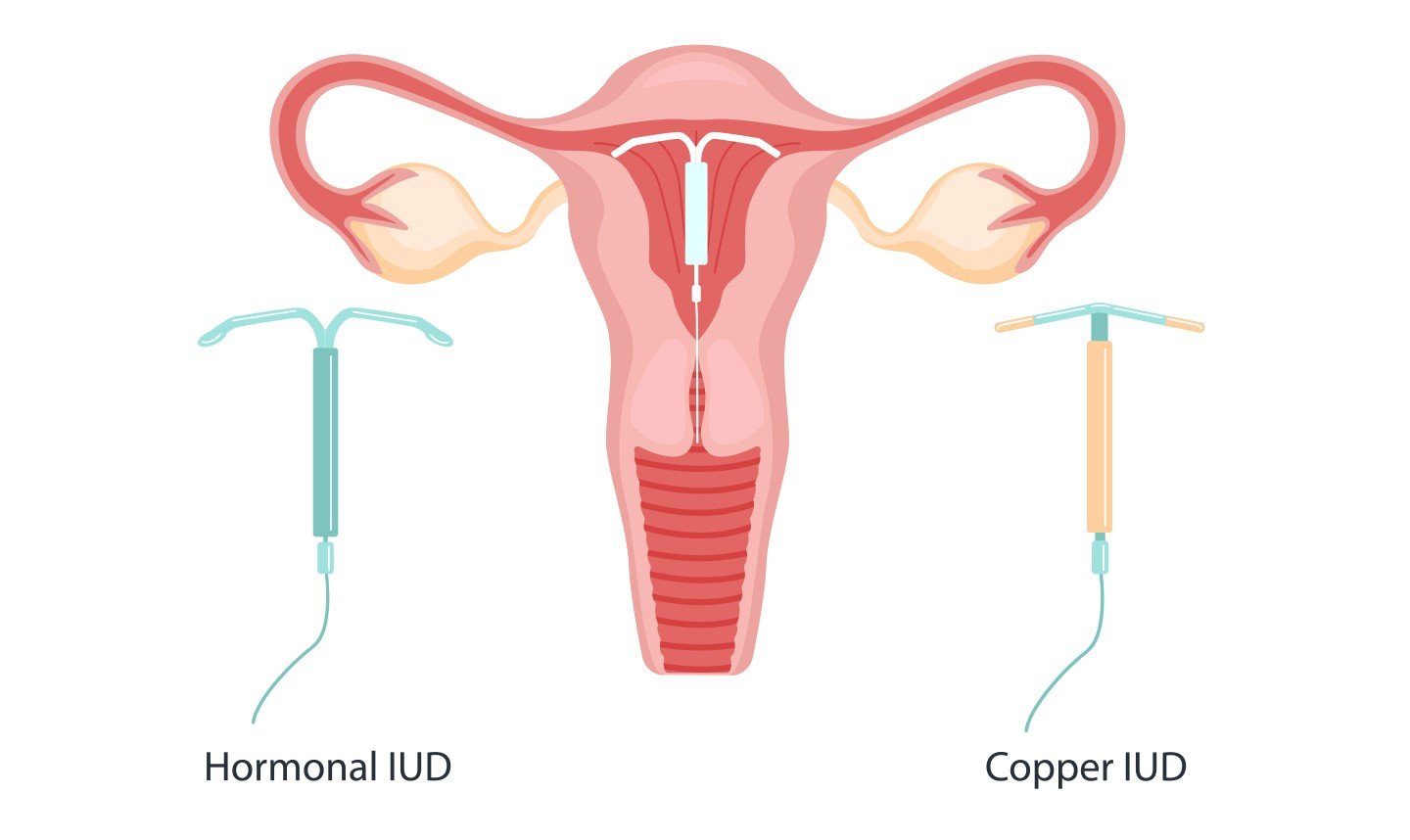 Intrauterine contraceptive device