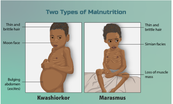 Marasmus and Kwashiorkor | CHAPTER 15 | Pediatric Nursing
