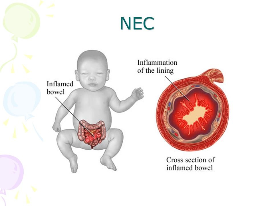 Necrotizing enterocolitis (NEC)