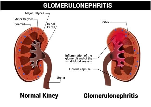 Nephritic syndrome | CHAPTER 12 | Pediatric Nursing