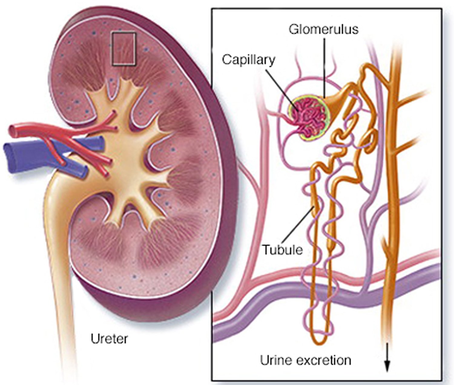 Nephritic syndrome | CHAPTER 12 | Pediatric Nursing