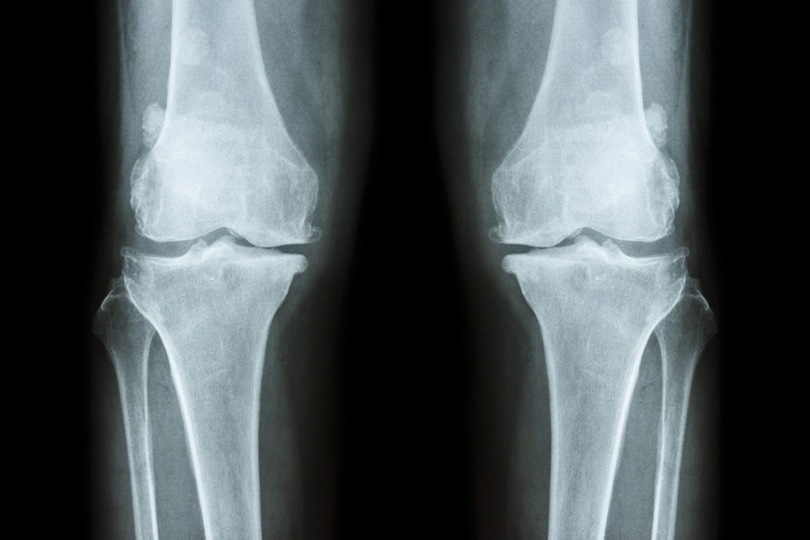 Important orthopedic terminology | CHAPTER 23 | Orthopedic Nursing