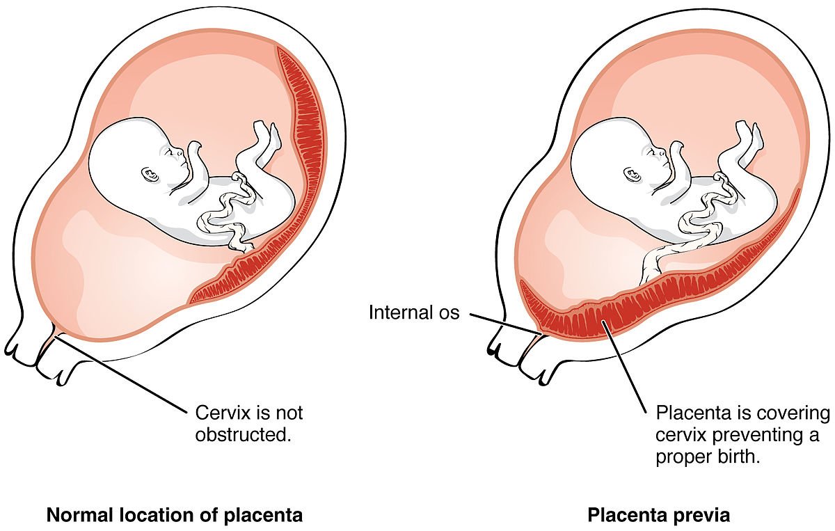 Post-Partum Hemorrhage (PPH)