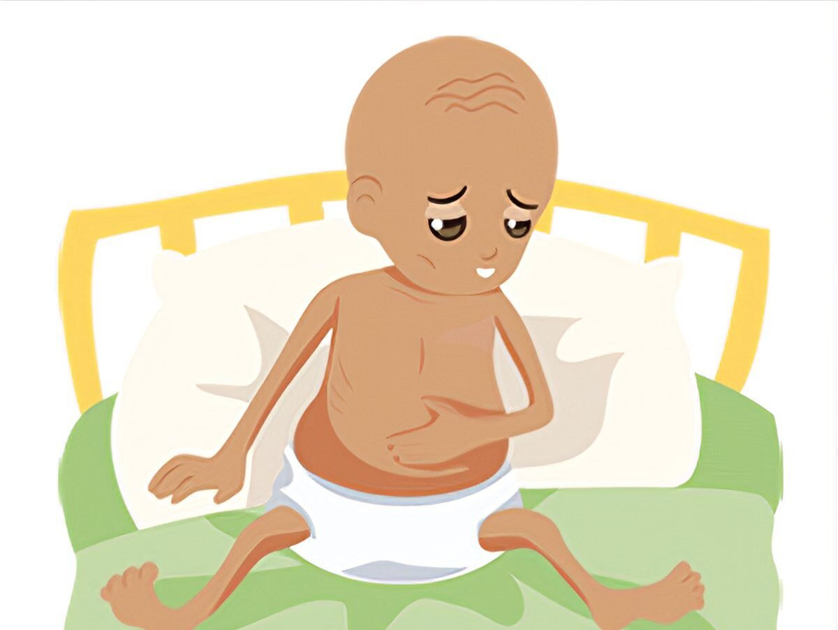 Protein Energy Malnutrition | CHAPTER 15 | Pediatric Nursing