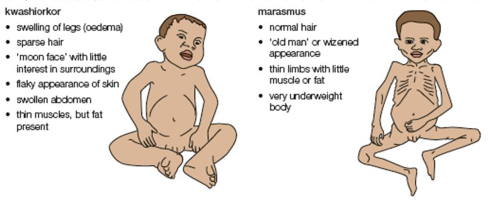 Protein Energy Malnutrition | CHAPTER 15 | Pediatric Nursing
