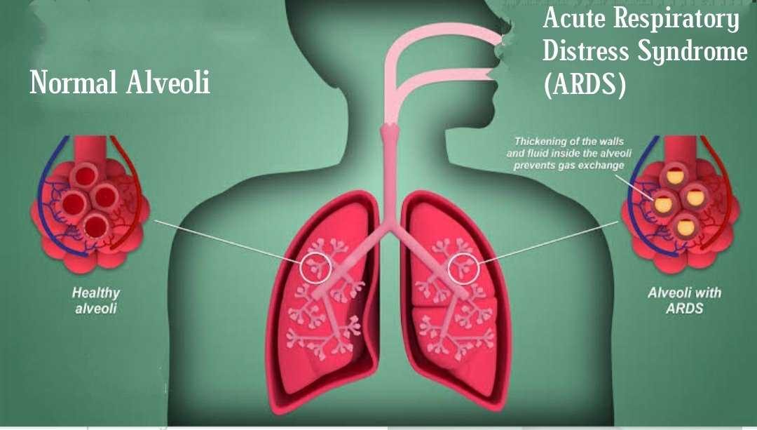 Classification of Respiratory distress syndrome (RDS)
