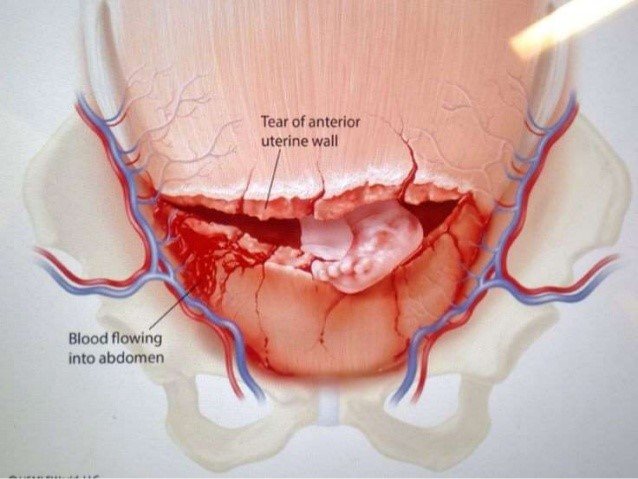 Rupture Of The Uterus