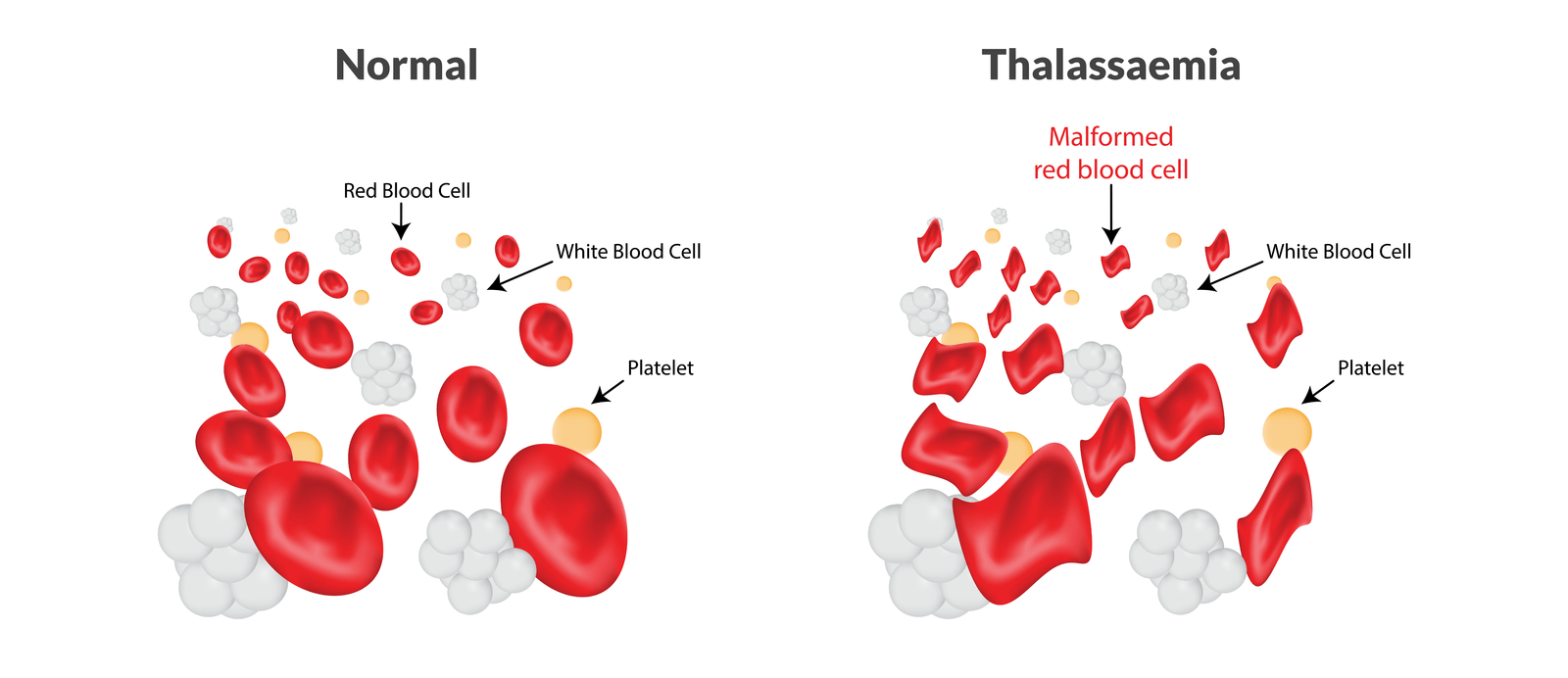 Concept of Thalassemia