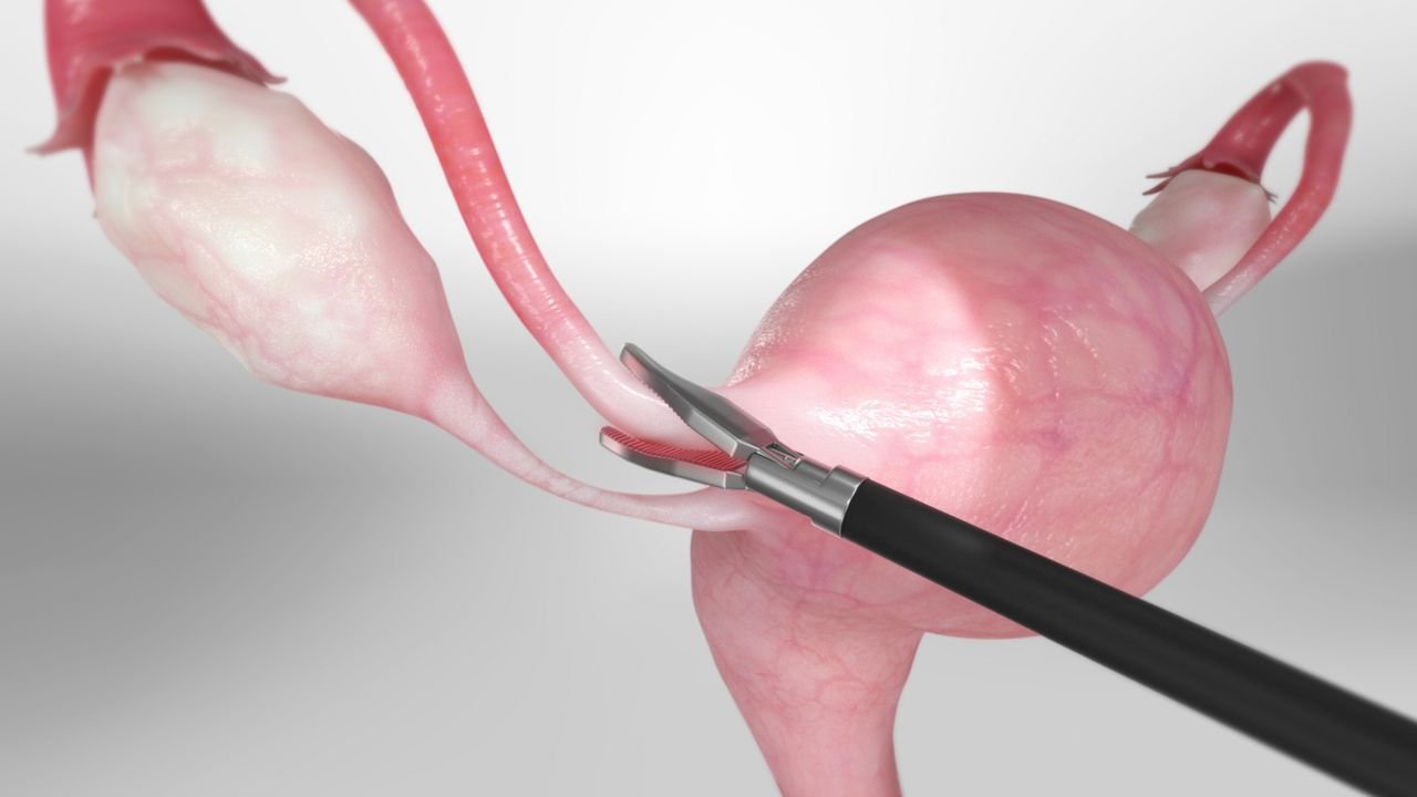concept of tubectomy