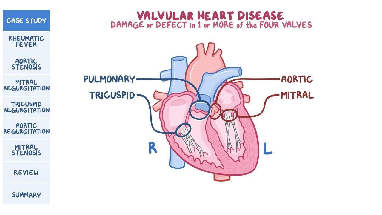 Valvular Heart Disease | CHAPTER 10 | Pediatric Nursing