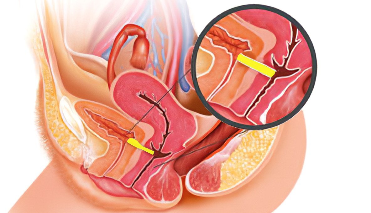 Vesicovaginal Fistula (V.V.F)