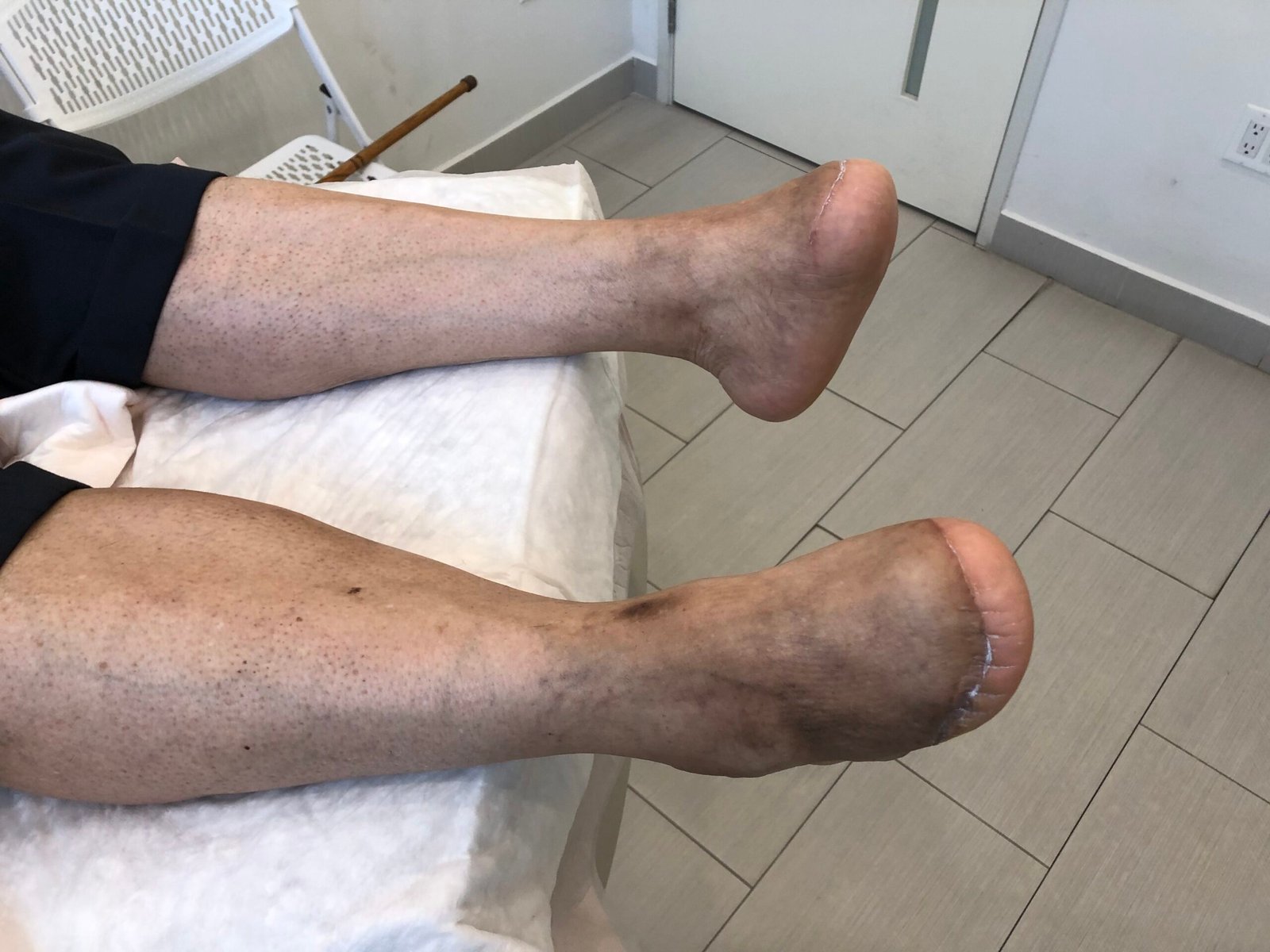 Definition of Amputation | CHAPTER 8 | Orthopedic Nursing