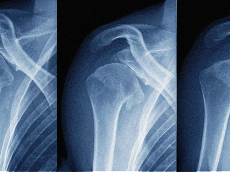 Anterior shoulder dislocation