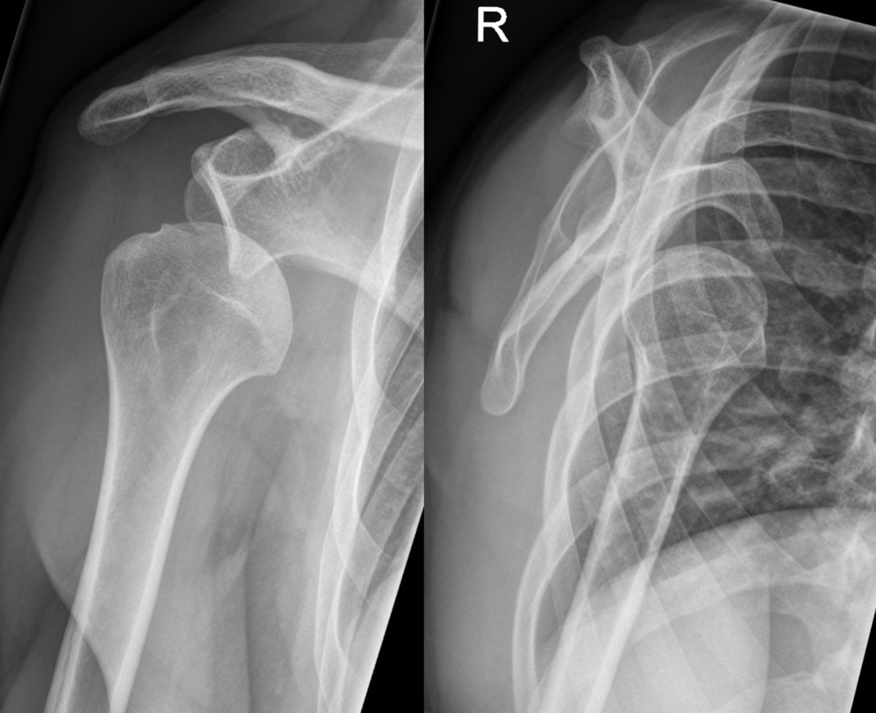 Anterior shoulder dislocation