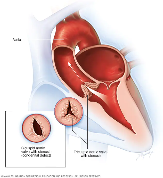 Aortic valve stenosis | CHAPTER 10 | Pediatric Nursing