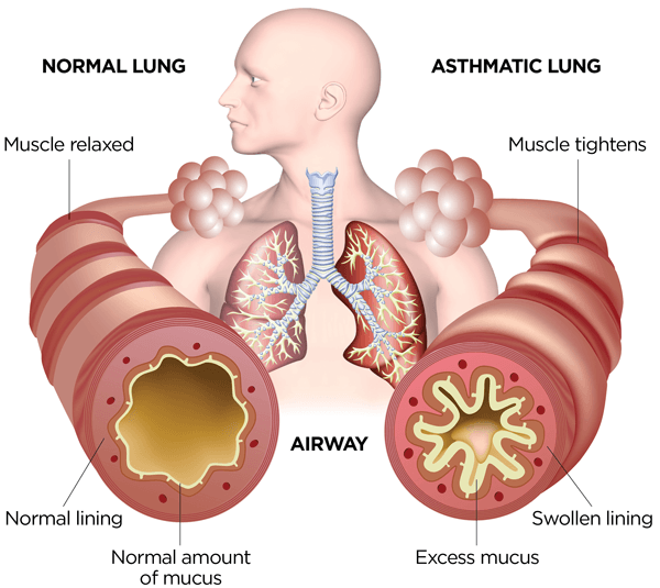 Definition of Asthma | CHAPTER-8 | Medical and Surgical Nursing