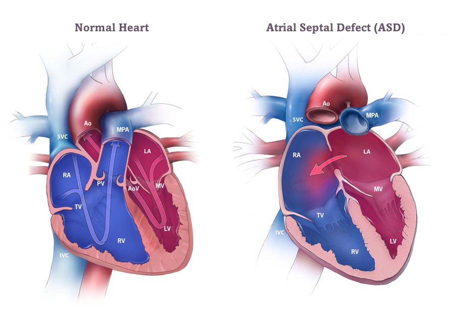 Atrial Septal Defect (ASD)