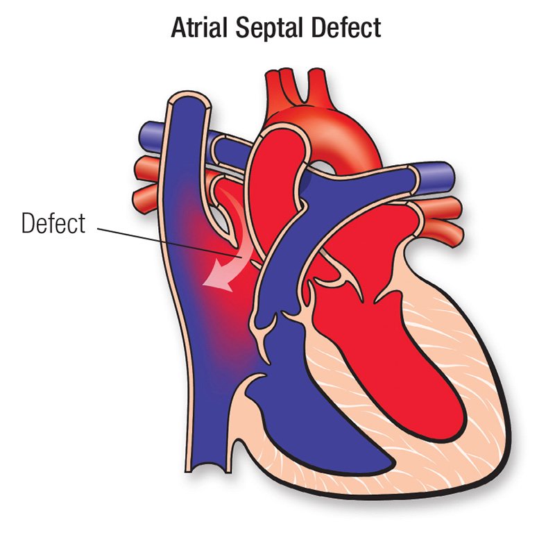 Atrial Septal Defect (ASD)