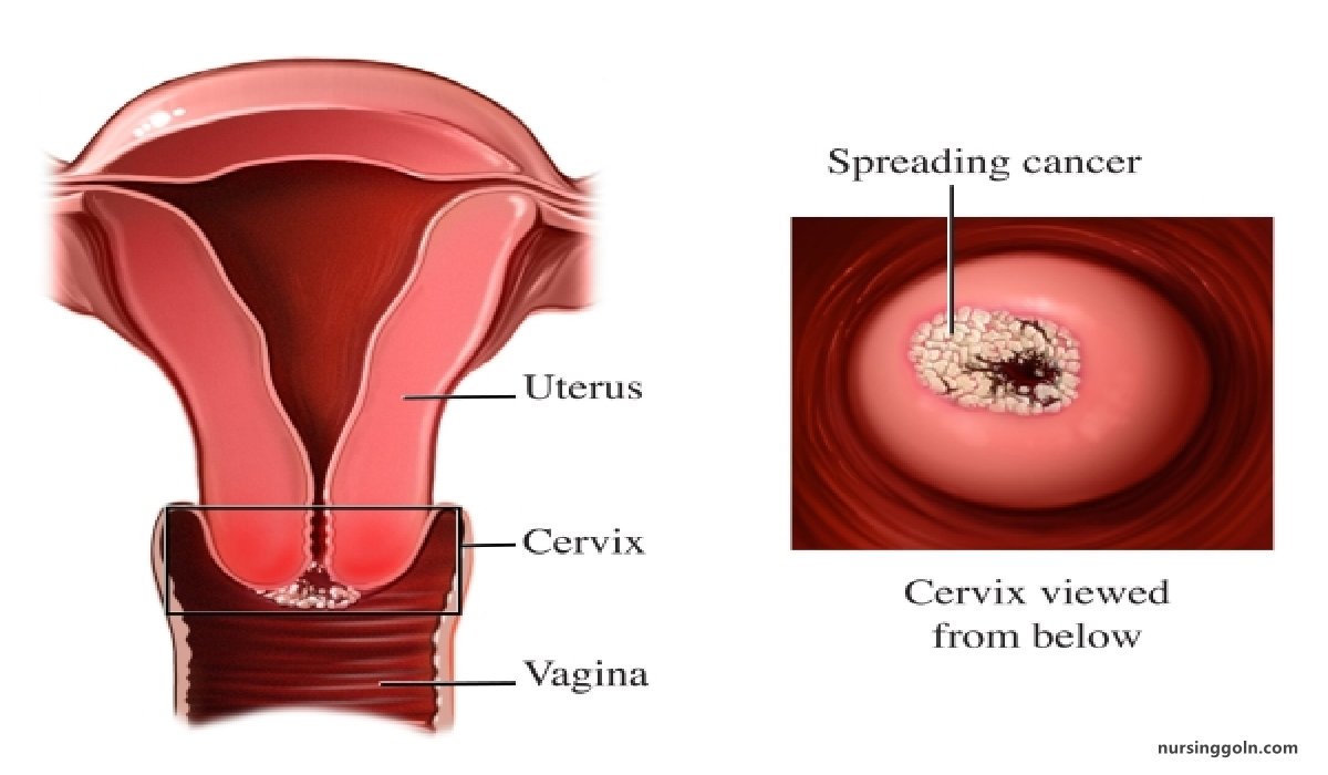 Cervical cancer | CHAPTER-12 | Medical and Surgical Nursing
