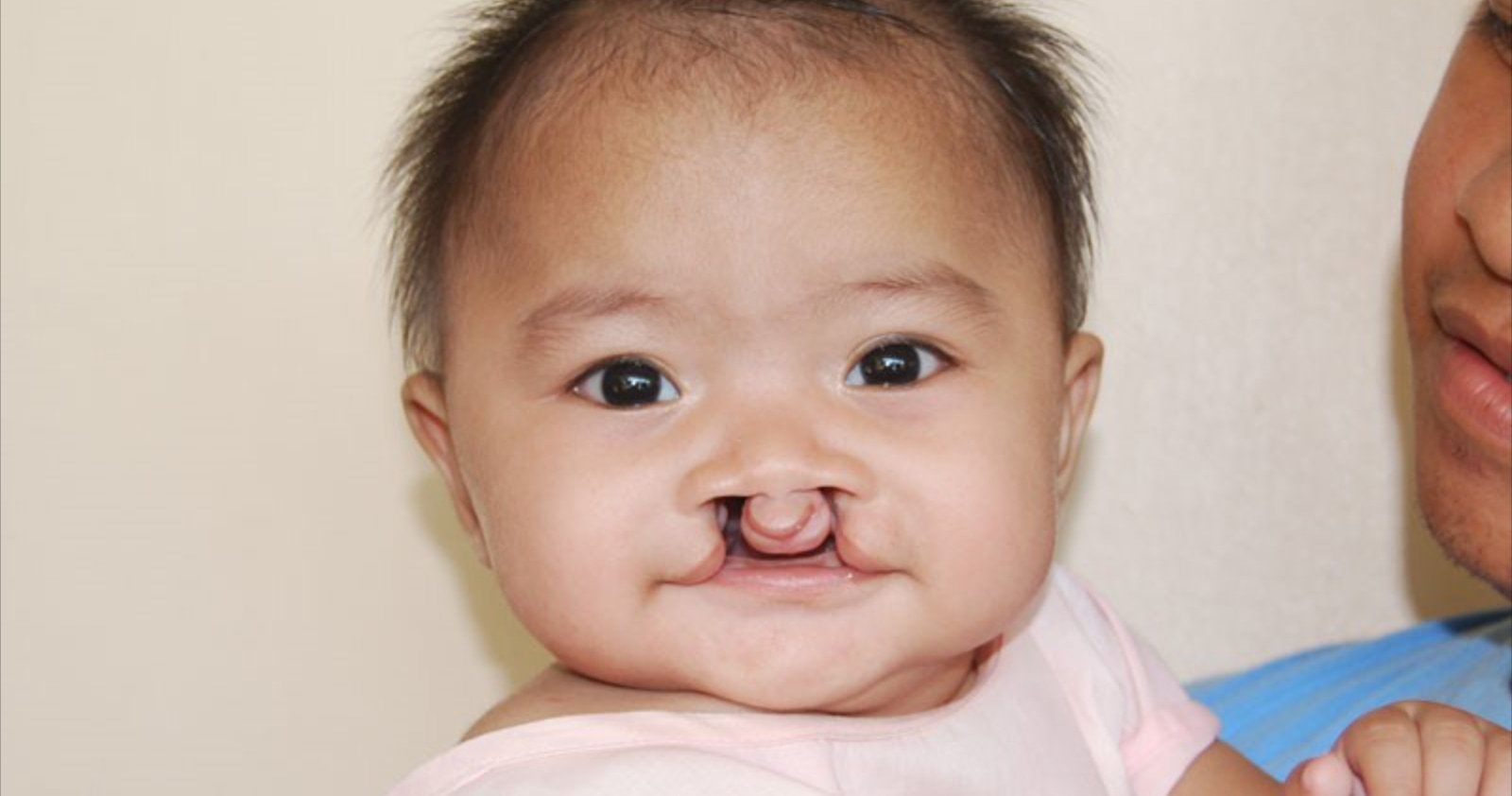 Cleft lip and cleft palate | CHAPTER 8 | Pediatric Nursing