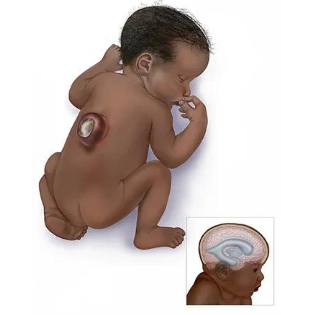 Congenital anomalies | CHAPTER 8 | Pediatric Nursing