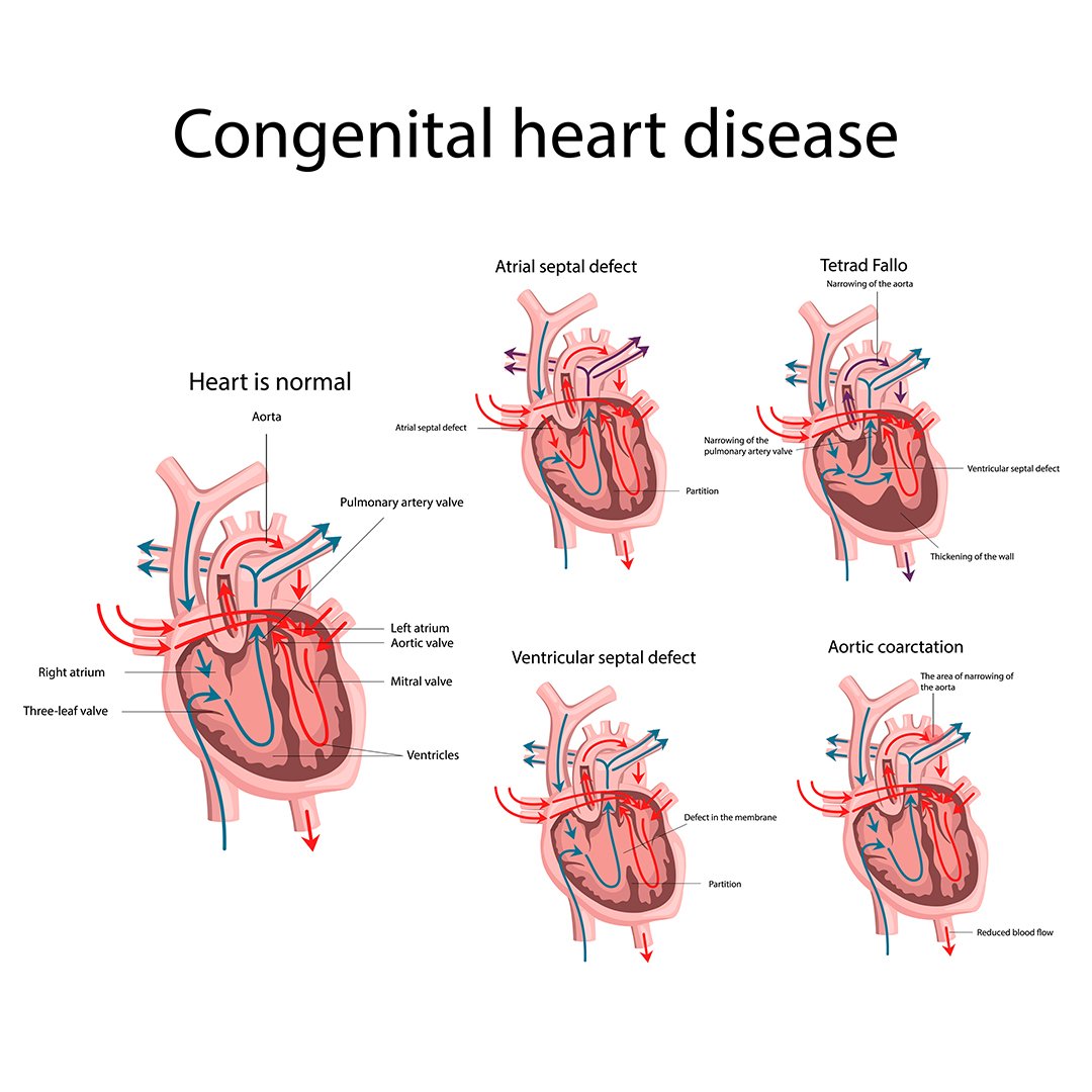 Congenital heart disease (CHD) | CHAPTER 8 | Pediatric Nursing