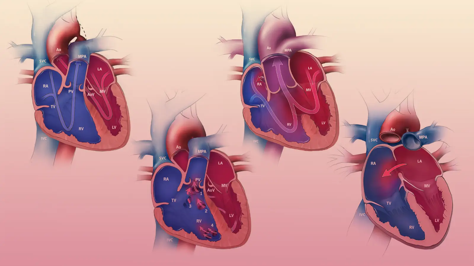 Congenital heart disease (CHD) | CHAPTER 8 | Pediatric Nursing