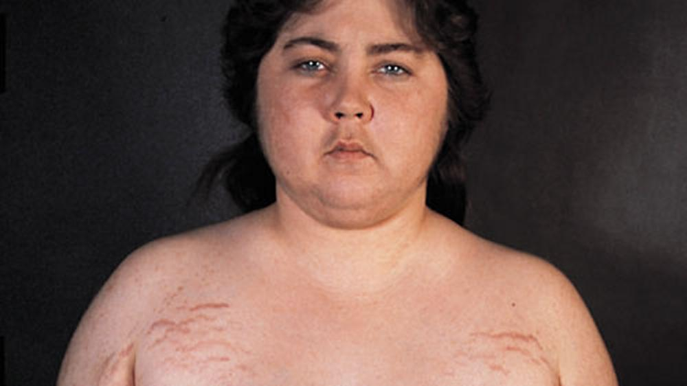 Cushing syndrome
