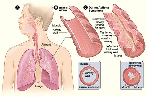 Definition of Asthma | CHAPTER-8 | Medical and Surgical Nursing
