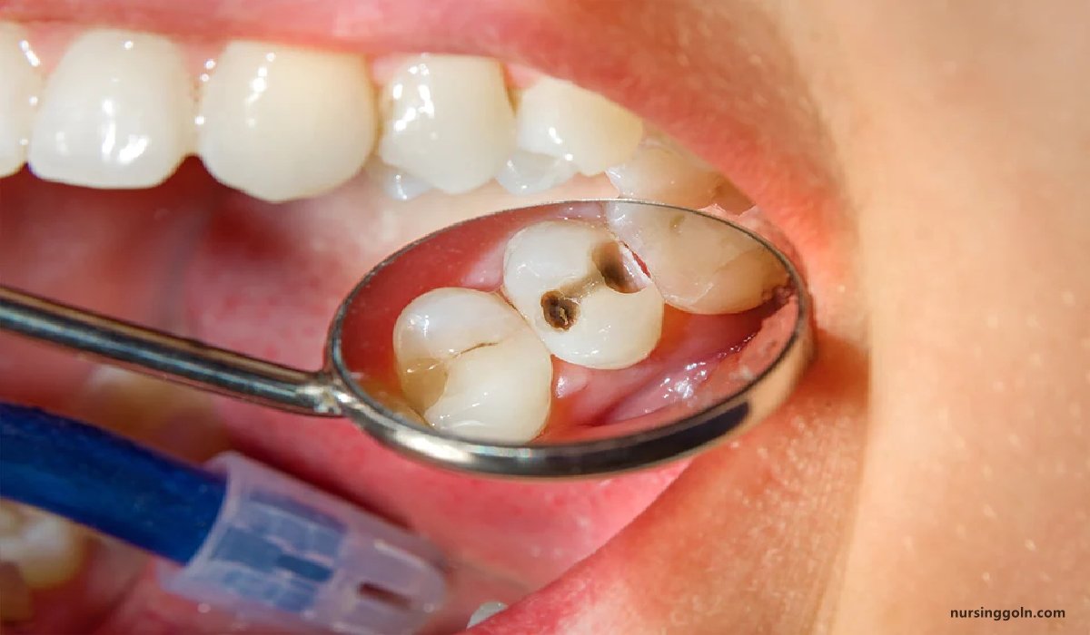 Dental caries | CHAPTER-10 | Medical and Surgical Nursing